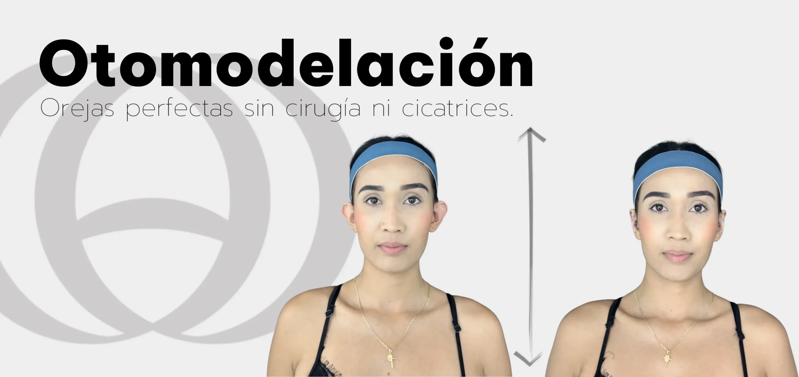 Otomodelación, Medellín, corregir, orejas, sin cirugía, otoplastia, estética, Anay Aesthetic